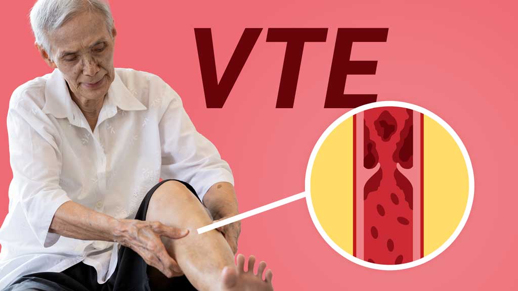 Cover image for: Venous Thromboembolism