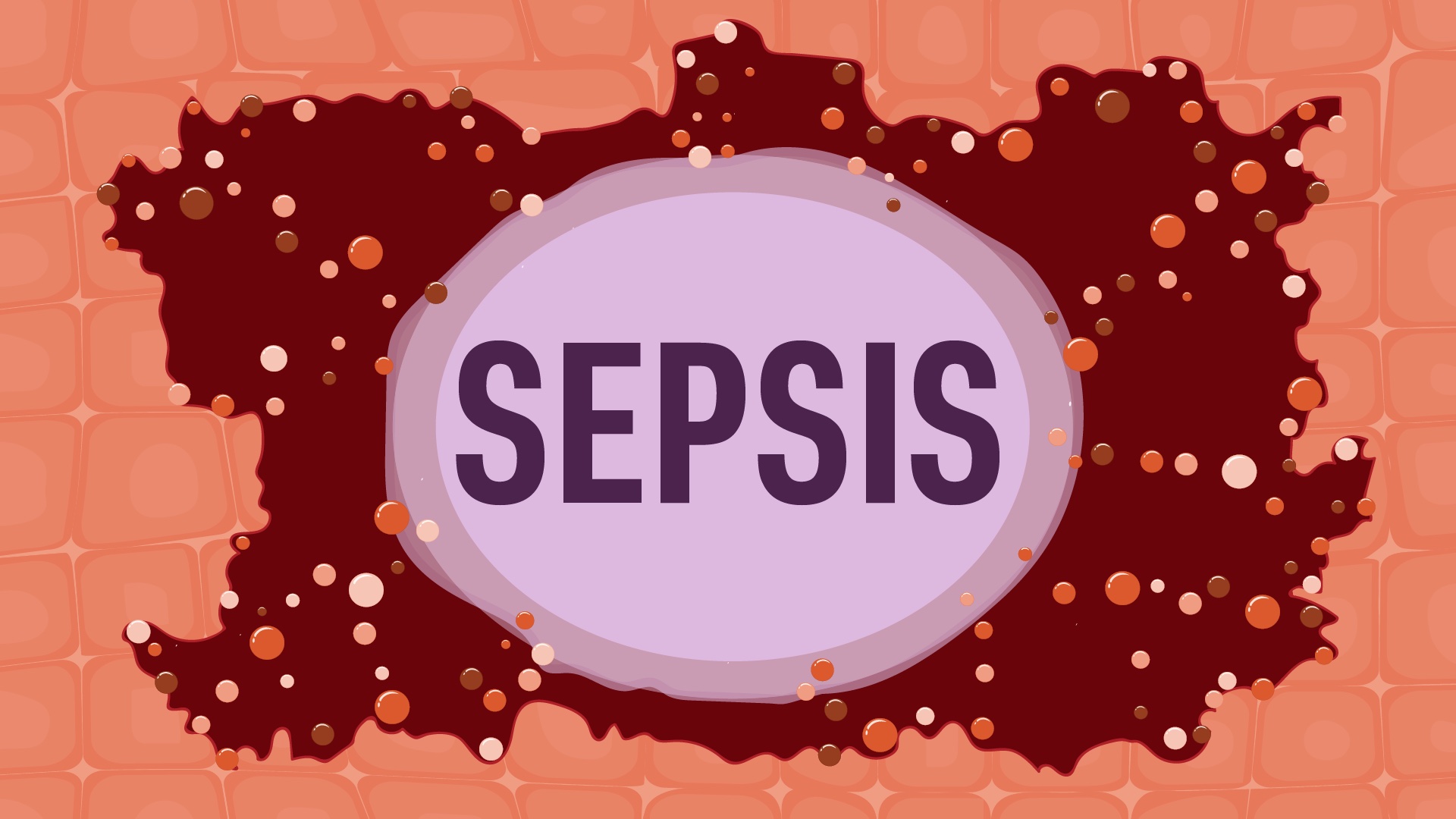 Cover image for: Sepsis