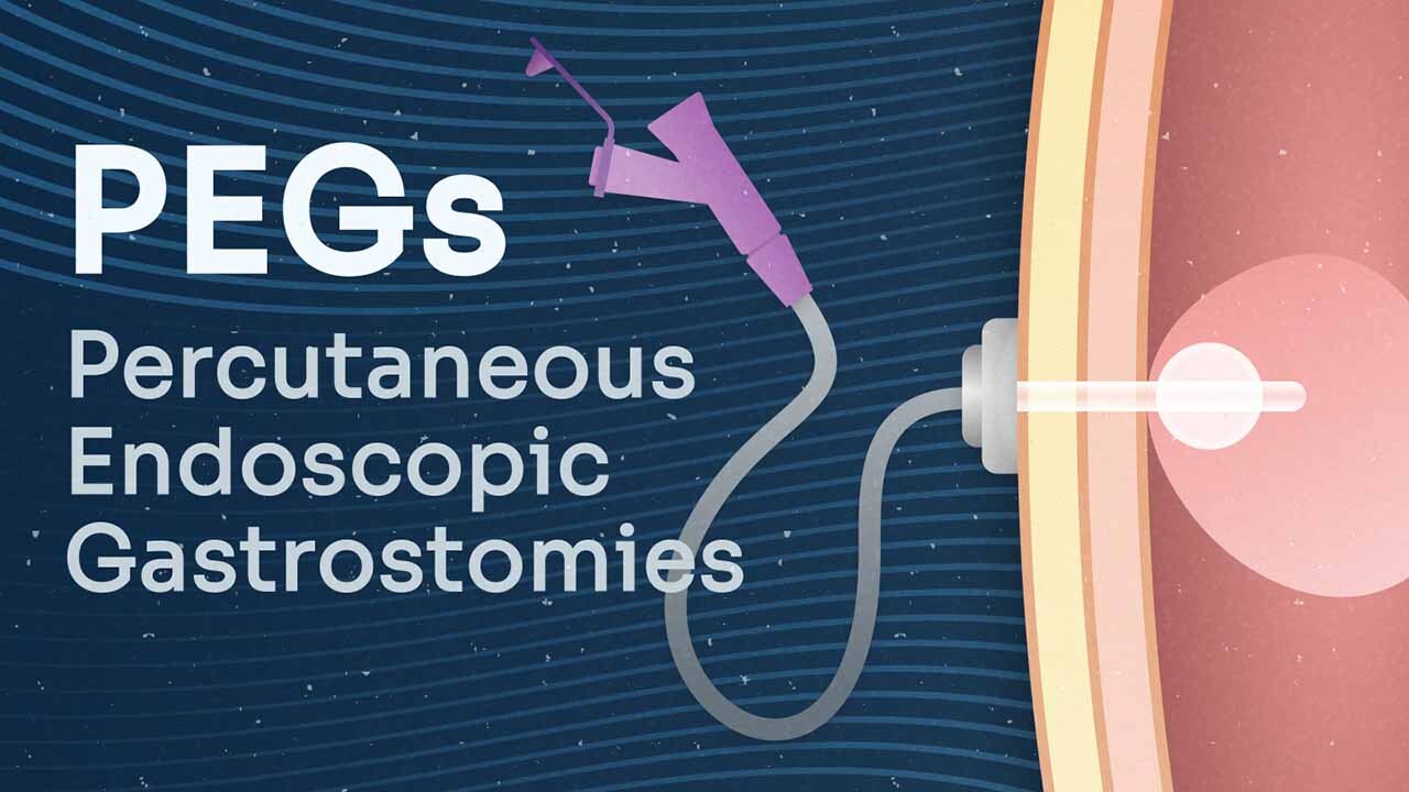 Image for Percutaneous Endoscopic Gastrostomies (PEGs)