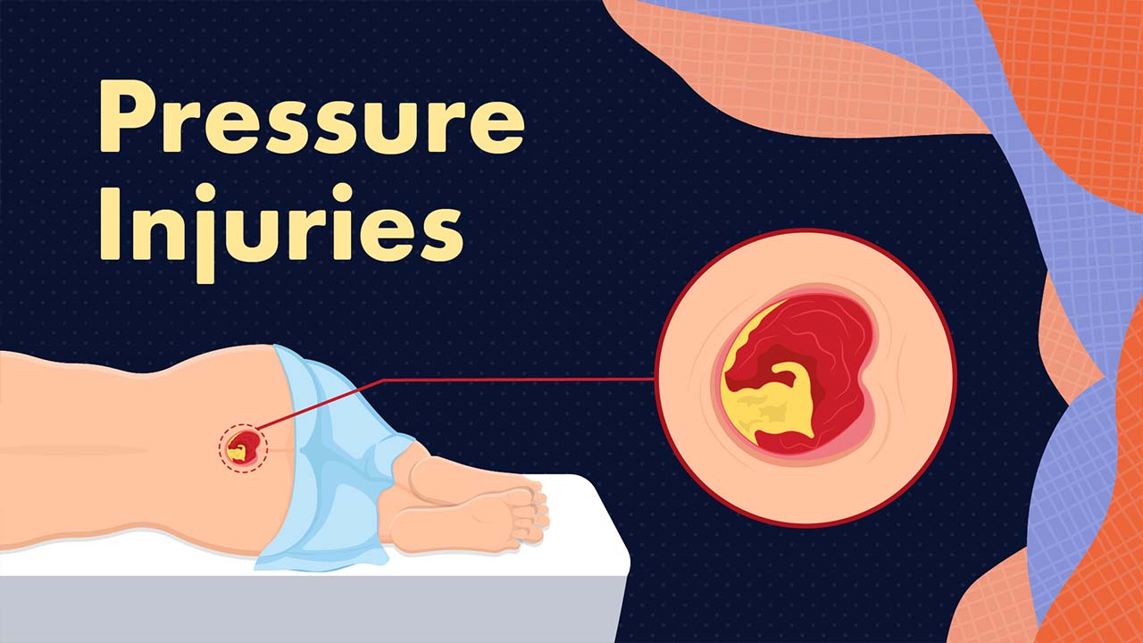 Cover image for: Pressure Injuries
