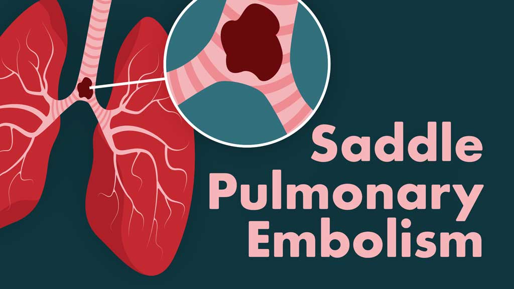 What is a Saddle Pulmonary Embolism (PE)? | Ausmed
