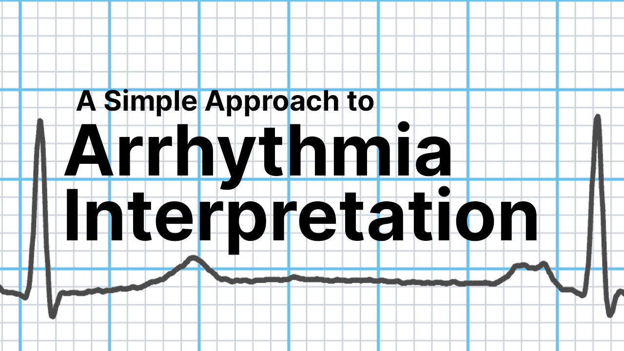 Cover image for: A Simple Approach to Arrhythmia Interpretation