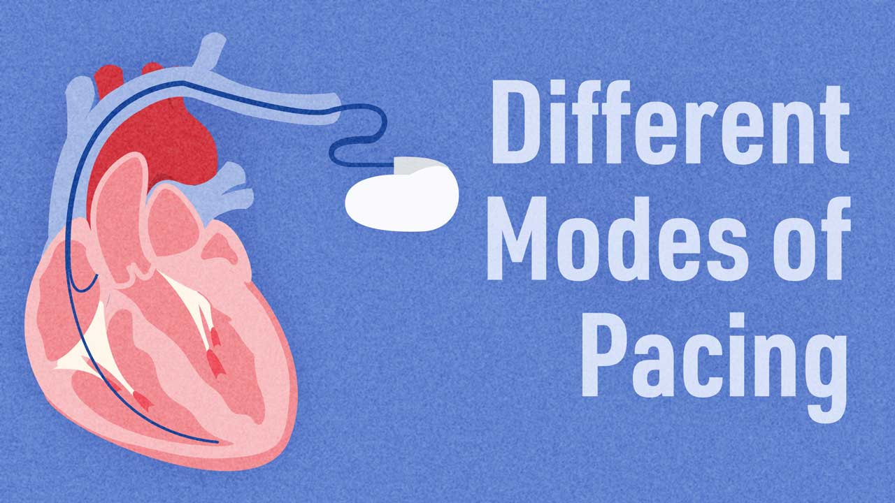 Image for Different Modes of Pacing